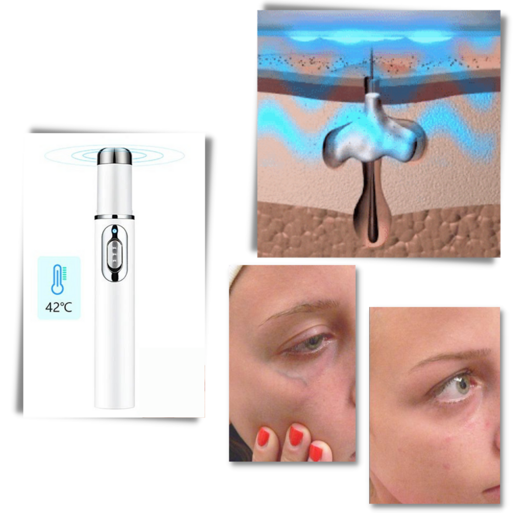 Blue light skin therapy pen